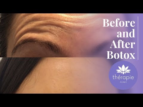 botox injekció a péniszbe