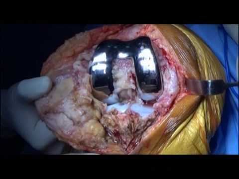 download lagu mp3 mp4 Dr Ashok Rajgopal Orthopaedic Surgeon, download lagu Dr Ashok Rajgopal Orthopaedic Surgeon gratis, unduh video klip Dr Ashok Rajgopal Orthopaedic Surgeon