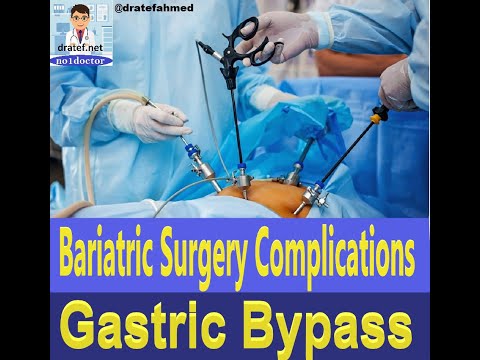 Bariatric Surgery Complications/Gastric Bypass Complications/Sleeve Gastrectomy/Weight loss surgery