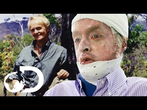 Burned Alive and Survived | My Shocking Story