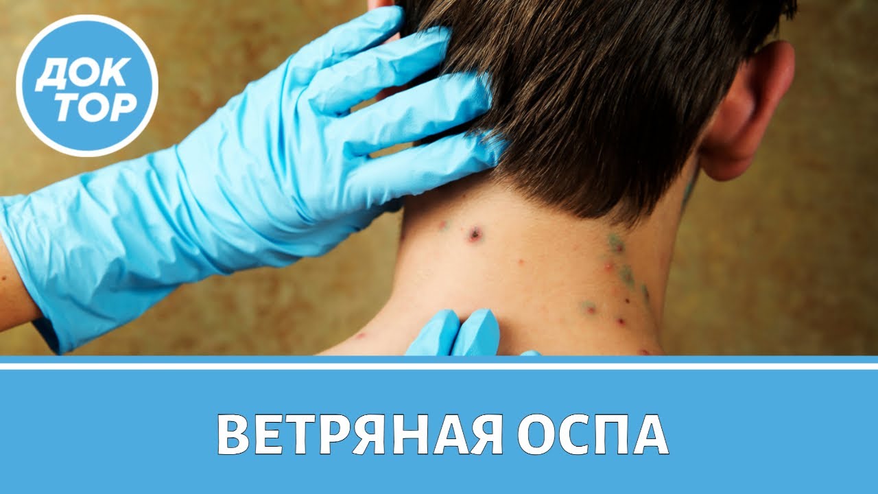 Ветрянка: переболеть или привиться