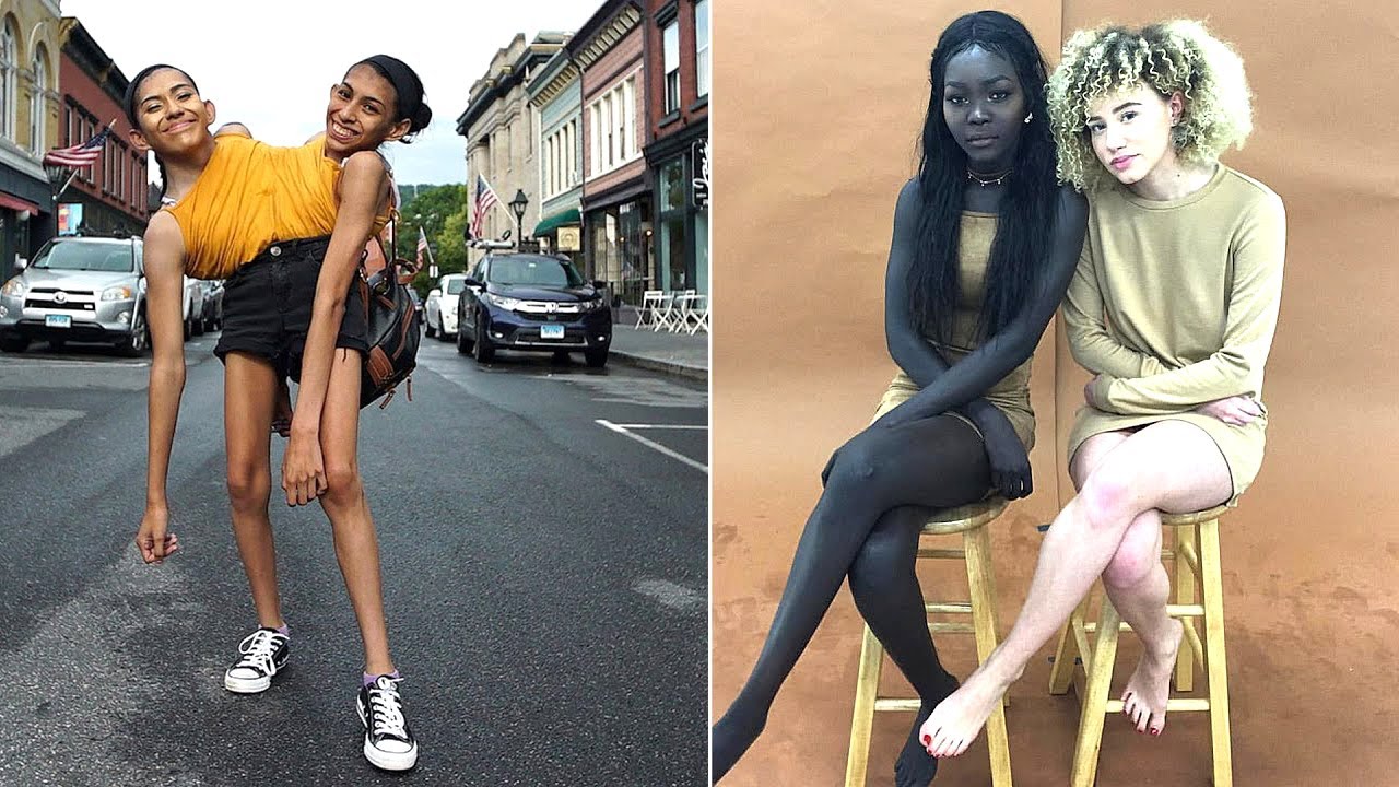 8 GÊMEOS INCOMUNS QUE NASCERAM DIFERENTES