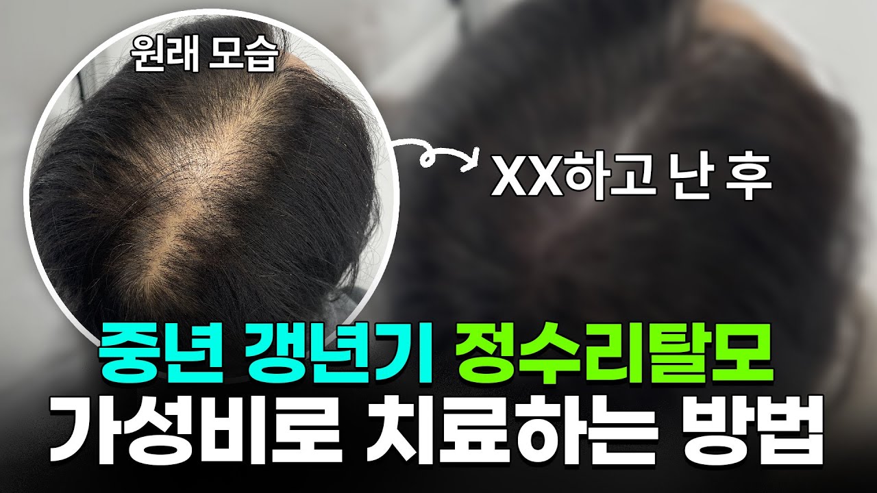 중년 여성 탈모 두피문신으로 가성비 탈모치료 가능(동안 효과는 덤)