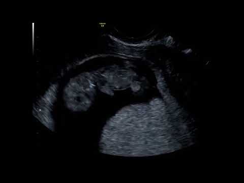 What Can You See At A 10 Week Baby Scan?