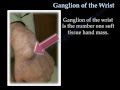 Ganglion Cyst Of The Wrist - Everything You Need ...