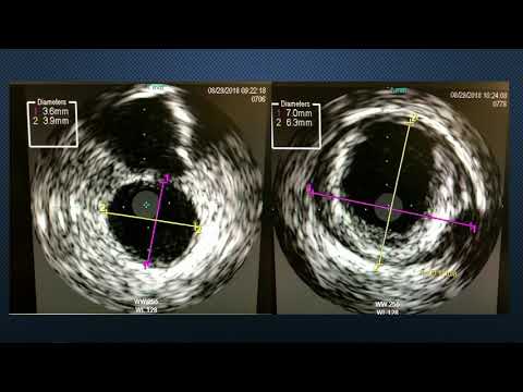 CVI 2019_Thursday, 7/18_ Coronary Challenging Case Competition Semifinals_Sarah Krause, RCIS