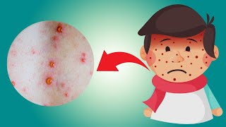 What Causes Baby Heat Rash? How to Reduce It