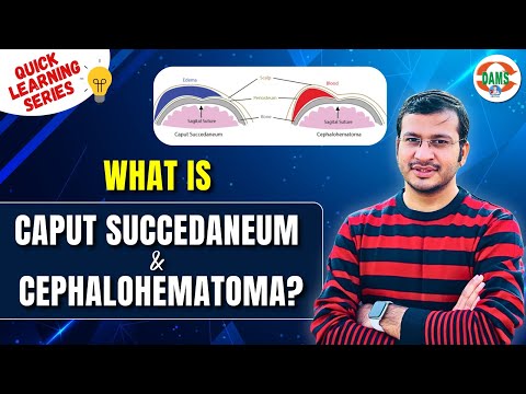 What is Caput Succedaneum & Cephalohematoma ? Quick Learning Series by Siddharth Sir | DAMS Nursing