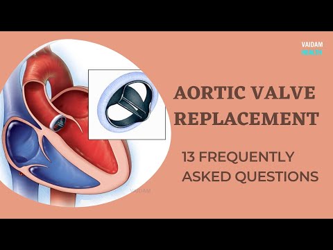 Aortic Valve Replacement - 13 Frequently Asked Questions