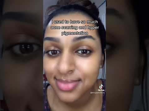 How I got rid of my acne scars and hyper pigmentation!!