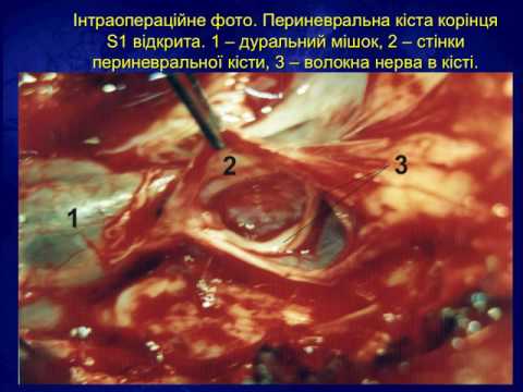 Ноющая боль в пояснице запор Барнаул эндопротезирование тазобедренного сустава