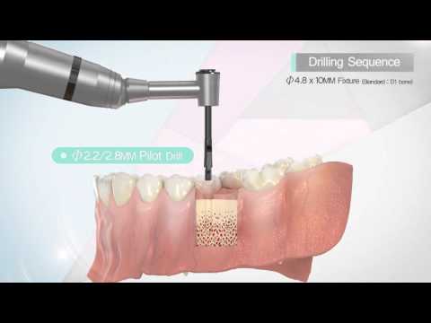 [DENTIS] Implant] DIK Kit Drilling Sequence