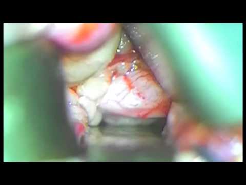 Optic Nerve Sheath Fenestration Video