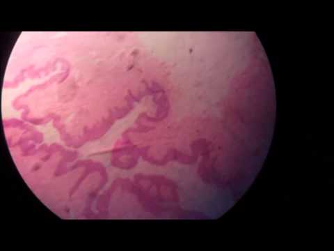 Lesioni del papilloma virus