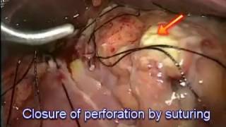 Laparoscopic Duodenum Perforation Repair surgery