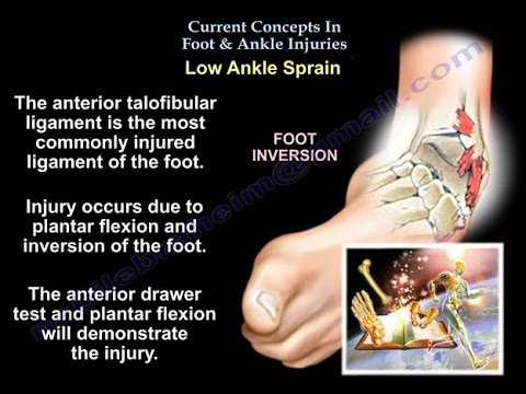 Foot and Ankle Injuries and fractures - Everything You Need To Know - Dr. Nabil Ebraheim