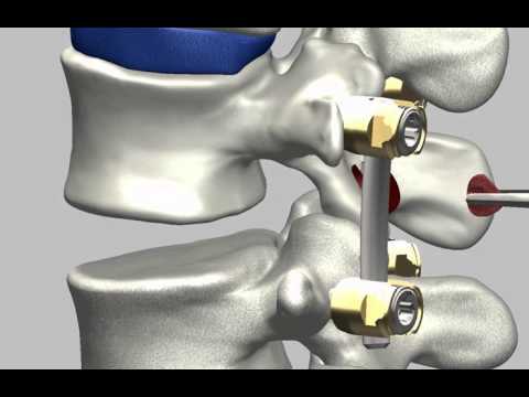 ADONIS PLIF Caja lumbar