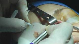 OR Video Footage: Refining The Tip of the Nose