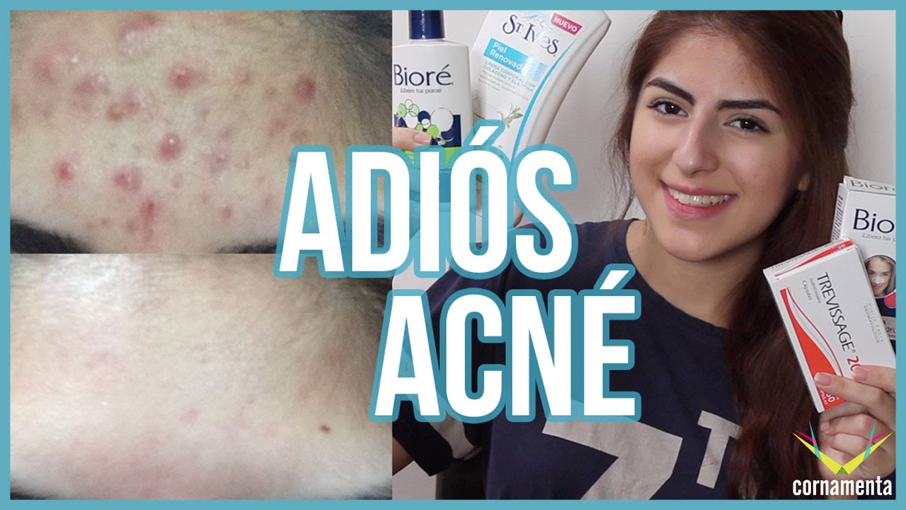 ADIÓS ACNÉ | Secretos + Tips