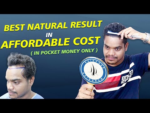 Best Natural Hair Transplant Result At Affordable Cost || In Pocket Money || HFHG Clinic India