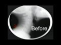 Arthrostim Instrument cineradiography