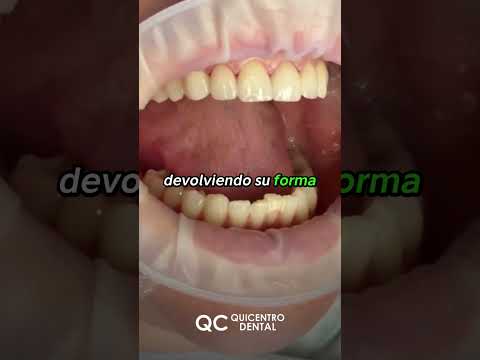 CORONAS DE ZIRCONIO - Quicentro Dental