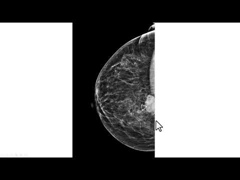 Mamografia craniocaudal mal posicionada, impedindo a identificalçao de um nódulo palpável.