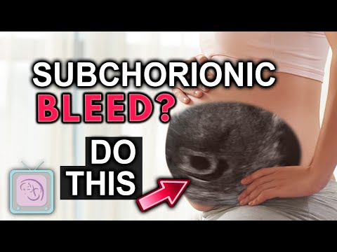 Subchorionic hemorrhage in pregnancy. Everything to know