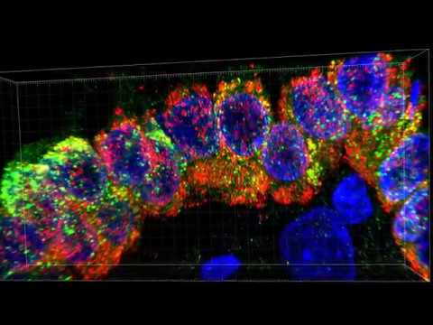 5 Month-Old Human Lung 39503 Containing Homozygous Missence ABCA3 Mutation