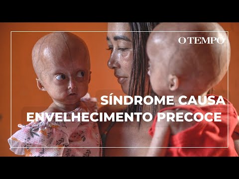 Síndrome da velhice precoce: conheça a história das gêmeas Elis e Eloá