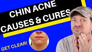 Chin Acne | Why You