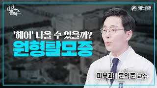 원형탈모증, '헤어' 나올 수 있을까? | 건강플러스 미리보기