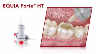 EQUIA Forte® HT - Restoration Guide