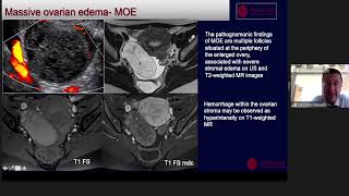 Oncological Imaging: Practical Approach - Mimics of Malignancy: Andexal' by Dr Gabriele Masselli