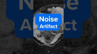 MRI Noise Artifact u2013 Why It Happens and How to Fix It