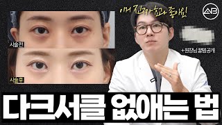 ✅수술 없이 다크써클 없애는 법