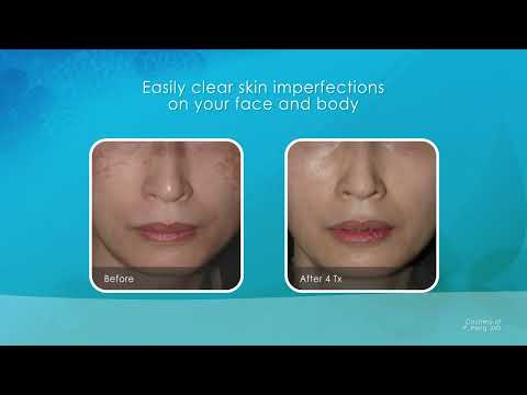 Cynosure Laser Pigmentation removal procedure
