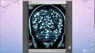 Parasitic Infections of CNS