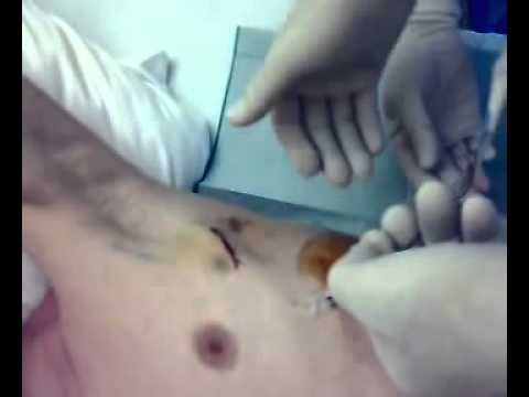 comment traiter pneumothorax