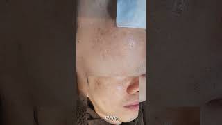 세네브 쎄네브 스킨부스터 mts로 직접 셀프시술 , 피부과 클리닉 대표원장 몬스터 의원