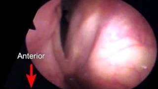 Bilateral laryngeal paralysis