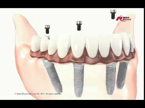 Video 4 FineDent - Experte für Zahnimplantate Dr. Robert Berdik in Düsseldorf