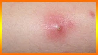 SOÑAR CON ABSCESOS EN EL CUERPO | SOÑAR CON ABSCESO DENTAL, ABSCESO DE PUS