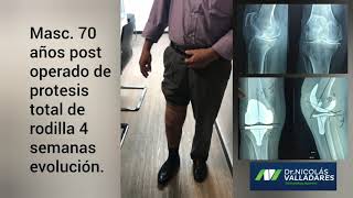¿ En cuanto puedo caminar normal después de una prótesis de rodilla
