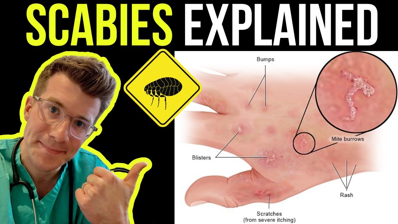 What Do Scabies Look Like Tipseri