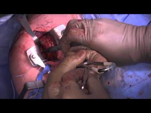 Procédure Latarjet: Présentation de cas et technique chirurgicale