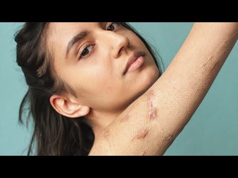 'Amo minhas cicatrizes, elas são parte de mim'