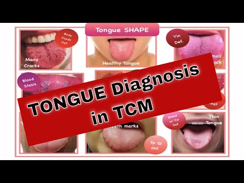 image-What can Chinese medicine tell from your tongue?