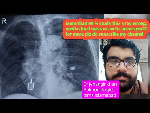 How to Read a Chest X-Ray: Essential Tips for Medical Professionals#chestxray #cxr #xray