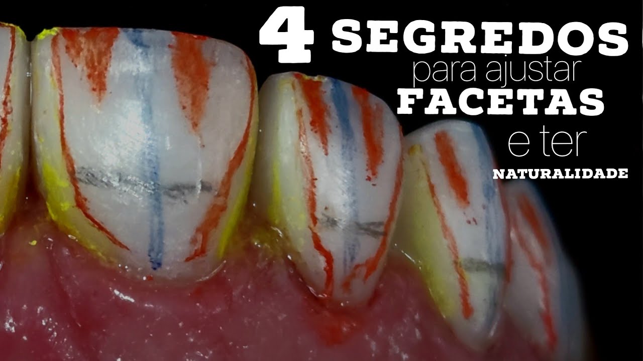 Watch Now 🛑4 SEGREDOS PARA FACETAS SUPER NATURAIS!PASSO A PASSO PARA IDENTIFICAR ERROS E MELHORAR SUAS FACETAS 🛑4 SEGREDOS PARA FACETAS SUPER NATURAIS!PASSO A PASSO PARA IDENTIFICAR ERROS E MELHORAR SUAS FACETAS